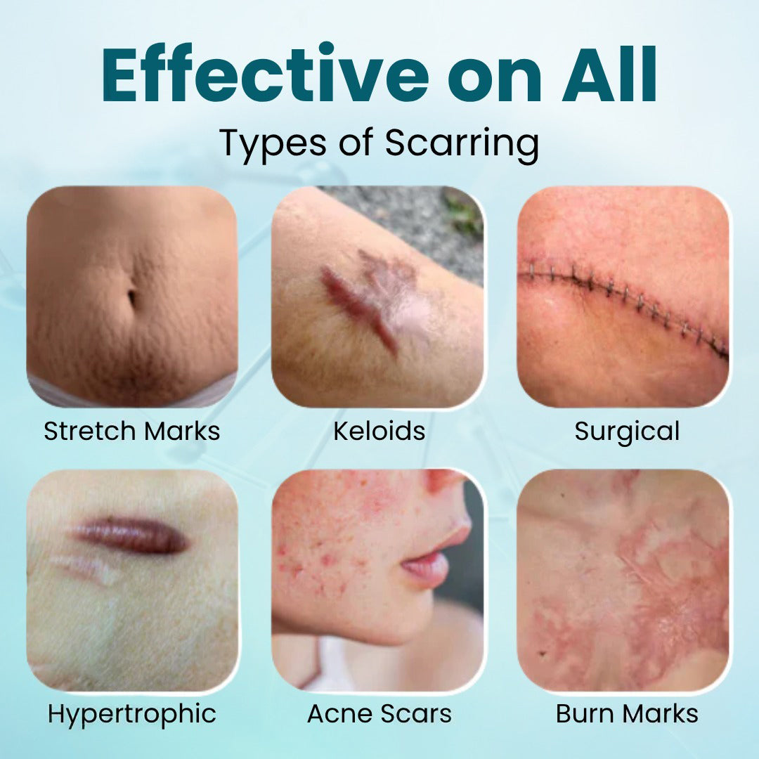 Advanced Medical Grade Silicone Scar Gel - Professional Treatment for C-Section, Surgery, Acne, & Burns (Old & New Scars)