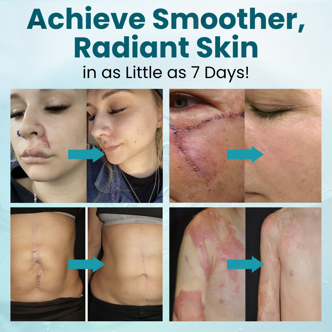 Advanced Medical Grade Silicone Scar Gel - Professional Treatment for C-Section, Surgery, Acne, & Burns (Old & New Scars)
